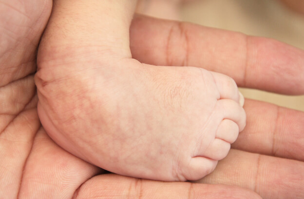 Club Foot (Congenital Talipes Equinovarus) Treatment at Danat Al Emarat
